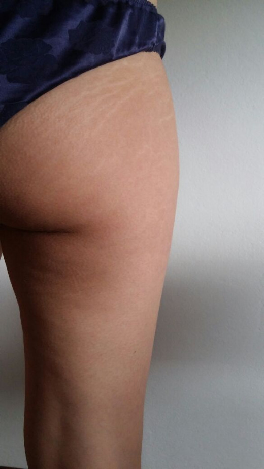 Le mie odiose smagliature!