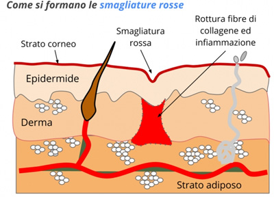 come si formano le smagliature rosse